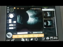 팬 스캔 B스캔 기계 10MHz 관측 망막 디태치먼트