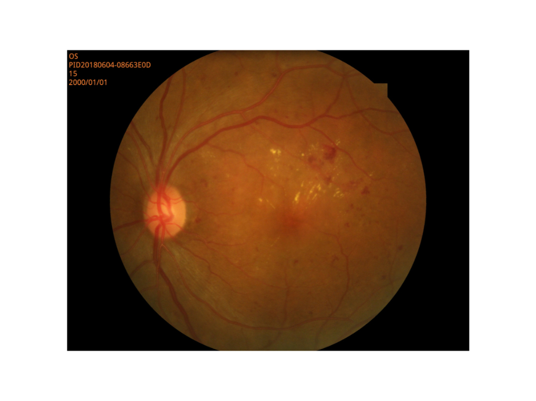 망막 이미지화 디지털 안저촬영기 작은 학생 모드 고해상도